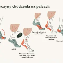 Ilustracja pokazuje, jak 10-letnie dziecko chodzi na palcach z powodu autyzmu, ADHD, dystrofii mięśniowej, przykurczu ścięgna Achillesa lub nadwrażliwości dotykowej.
