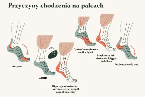 Ilustracja pokazuje, jak 10-letnie dziecko chodzi na palcach z powodu autyzmu, ADHD, dystrofii mięśniowej, przykurczu ścięgna Achillesa lub nadwrażliwości dotykowej.